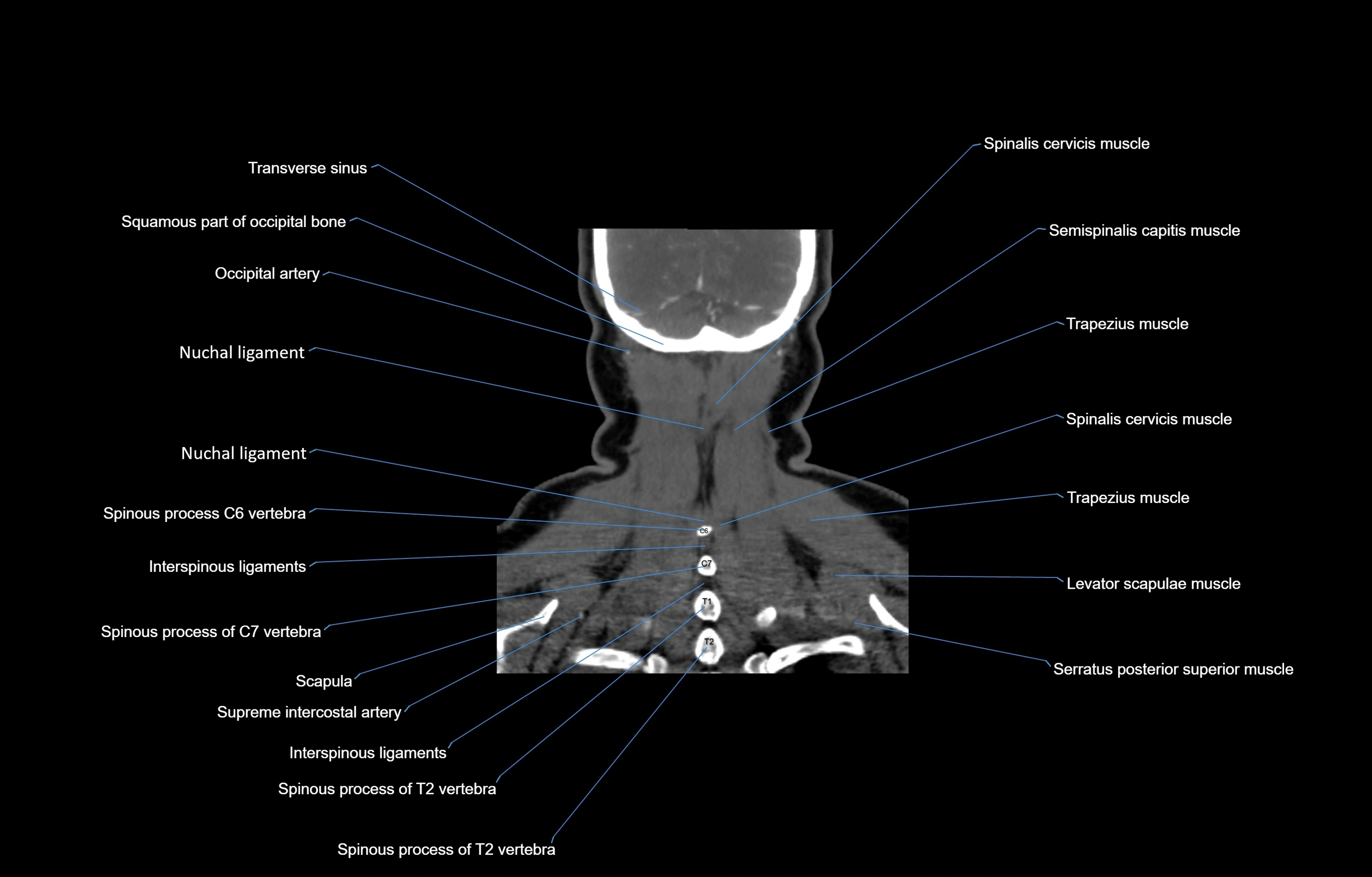 CT Neck coronal  cross sectional anatomy labelled 3D  radiology  image-00057.webp